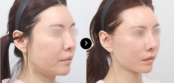 Semi-Face Lifting image 1