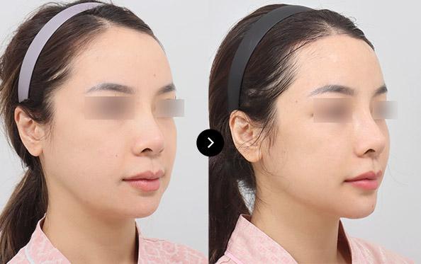 Mini Incision Face Lifting image 2