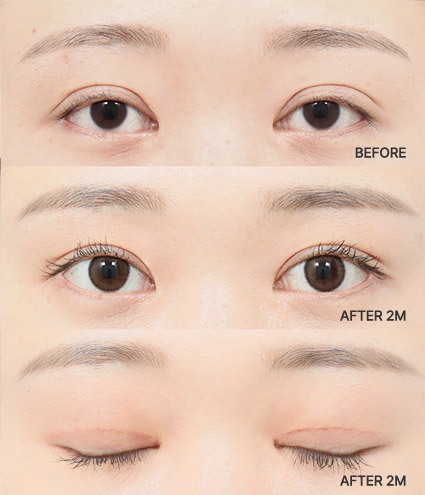 Transform Your Look with Korean Eye Surgeries: A Comprehensive Guide ...